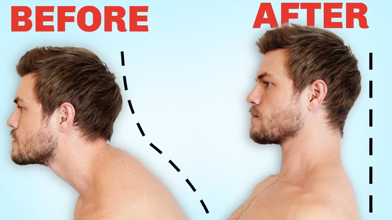 Unlocking Better Posture: A Comprehensive Guide to Fixing Forward Head Posture